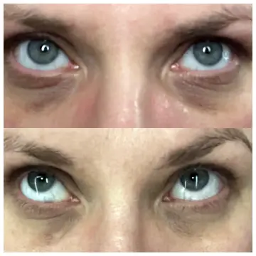 Alastin Restorative Eye Treatment