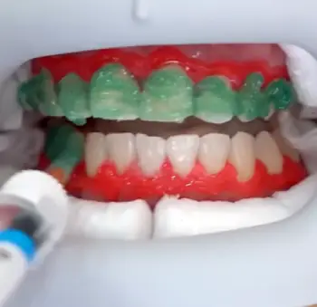 Odalit Teeth Restoration 