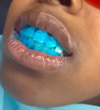 Odalit Teeth Restoration