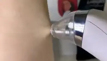 Aphrodite Blackhead Treatment 