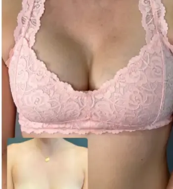 Dyceco Breast Enhancement Patch 