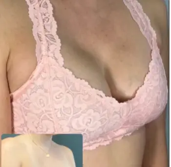 Dyceco Breast Enhancement Patch 