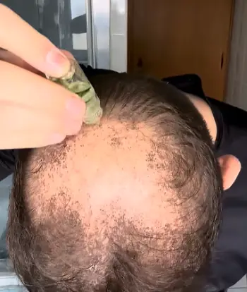 Alphainfuse Hair Regrowth