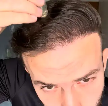 Alphainfuse Hair Regrowth