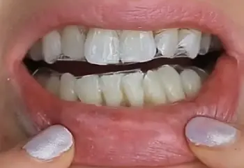 Brookstone Whitening Strips 