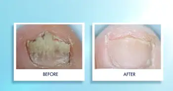 Proclearz Fungal Shield
