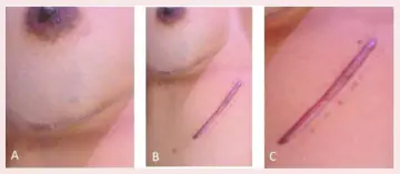 Dermatix Scar Reduction Silicone Gel  