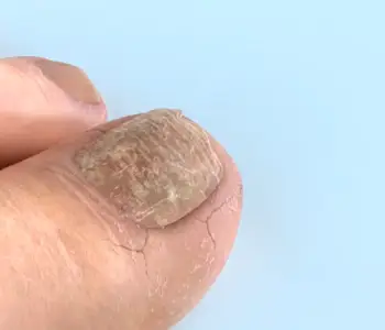 Proclearz Fungal Shield